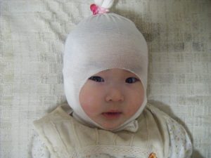 【アトピー奮闘記4】ネットで買った掻きむしり対策グッズは「チュビファースト」ちび姫ちゃん装着後